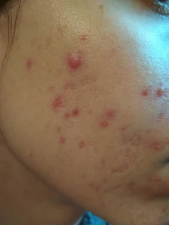 como eliminar ACNE