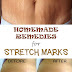 5 Effective Home Remedies for Stretch Marks