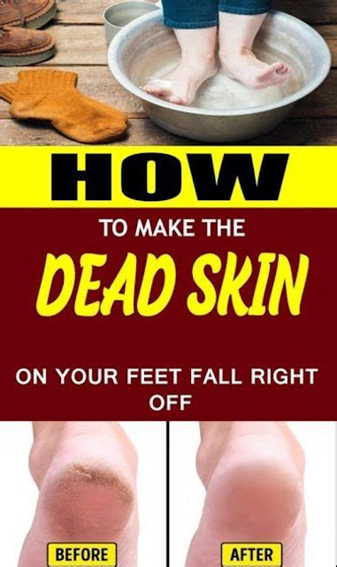 Foot Soak For Dead Skin That Actually Works