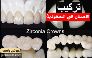 اسعار تركيب الاسنان الزيركون في السعودية