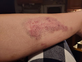 A white woman's calf with a dark, hand sized, red/ purple bruise running down the inside. You can see all of her pores because they are dark purple.