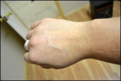 itchy arm close up