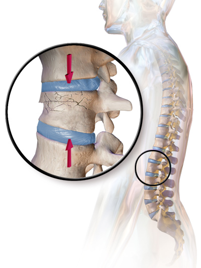 Lumbar Compression Fracture Treatment | Surgery