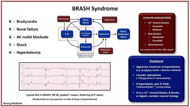 Brash Syndrome ecg