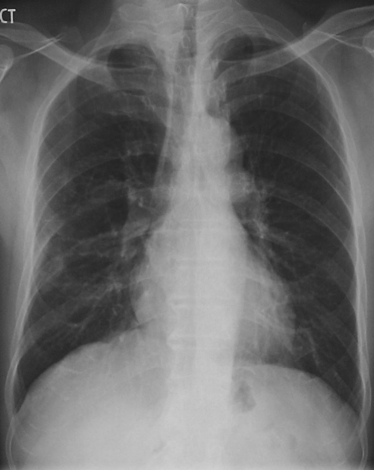 Learning Chest Radiology: Case 325  Asbestos exposure