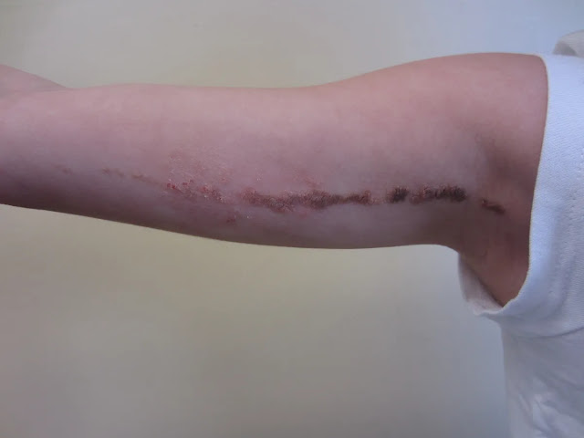 imagen de nevus epidérmico lineal verrugoso inflamatorio en la parte superior del brazo. Curiosciencia