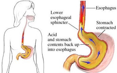 http://informasiherbalalamiseindonesia.blogspot.com/2015/06/atasi-penyakit-maag-untuk-ibu-hamil.html