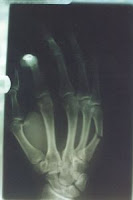 fractured hand xray