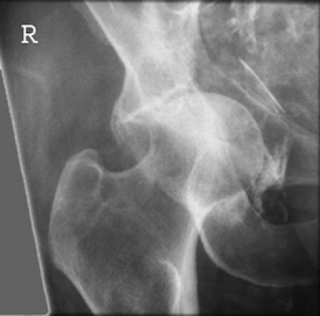 REVERSE JUDET'S PROJECTION HIP JOINT POSTERIOR OBLIQUE
