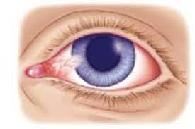 5 ways to reduce eye irritation and pain, why eye irritation, to reduce eye irritation, eye irritation or eye strain, to get rid of eye irritation and itching