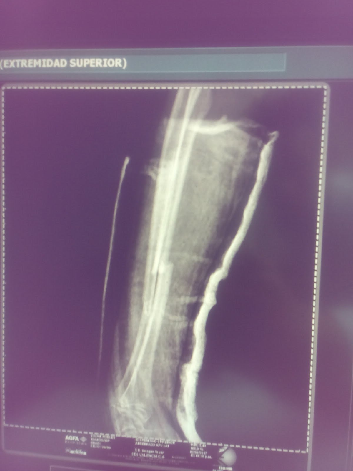 Rayos X de una inmovilización de radio y cúbito