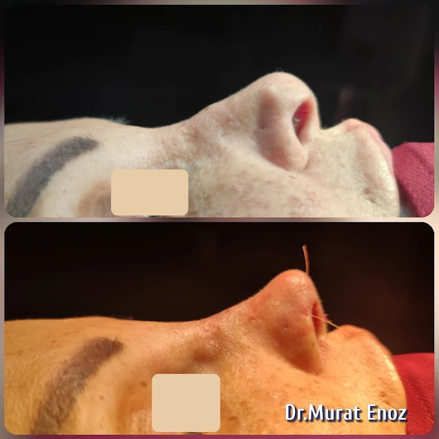 Complicated 3rd Revision Nose Aesthetic,tertiary revision nose aesthetic surgery,Tertiary revision nose job in Istanbul,