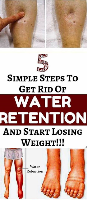 How to Get Rid of Water Retention and Lose Weight With 5 Simple Steps