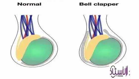 Complications-of-testicular-trauma-and-home-care-for-it