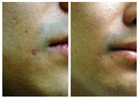 Scar Removal Before And After