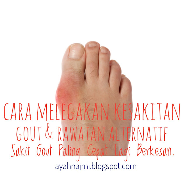 Cara Melegakan Kesakitan Gout Dan Rawatan Alternatif Sakit Gout Paling Cepat Lagi Berkesan