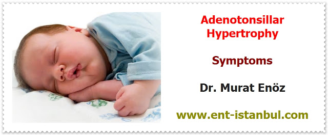 Definition of Tonsils and Adenoids - Why Tonsils and Adenoid Enlarged? - Symptoms of Enlarged Tonsils and Adenoid - Negative Effects of Adenotonsillar Hypertrophy on Child Personality and Behavior - Tonsillar Asymmetry
