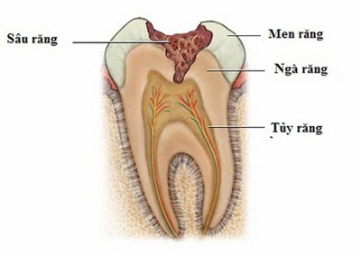 3 mức độ sâu răng bạn nên biết