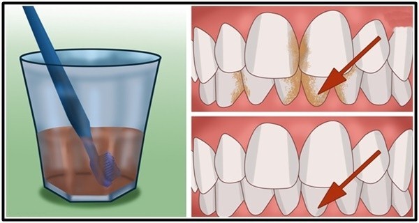 Inilah Cara Membersihkan Karang Gigi dan Memutihkan Gigi Kuning Dengan Cepat dan Mudah