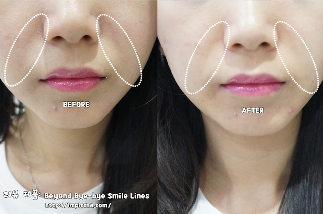 before and after use Beyond Bye-bye Smile Lines