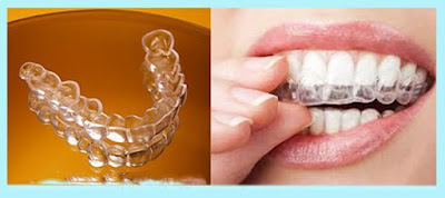 Cách tự niềng răng tại nhà có hiệu quả như truyền miệng?-2