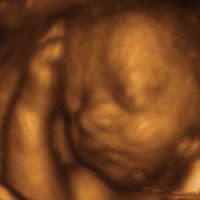 3d Ultrasound Images2