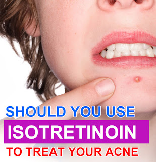  Isotretinoin to Treat Acne