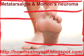 Metatarsalgia & Morton’s neuroma