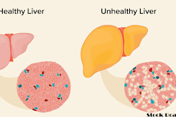 फैटी लीवर के लक्षणों के प्रभाव: फैटी लिवर डिजीज स्टेज का संकेत देती हैं ये समस्याएं (Effects of Fatty Liver Symptoms: These Problems Indicate Fatty Liver Disease Stage)