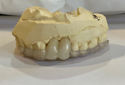 Essix retainer is an excellent prosthesis that helps to relieve external pressure on delicate healing tissues