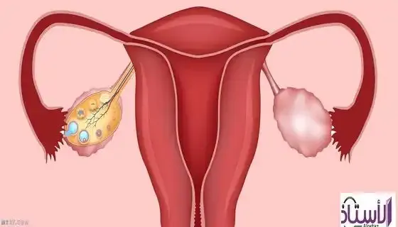 Adenomyosis-of-the-uterus