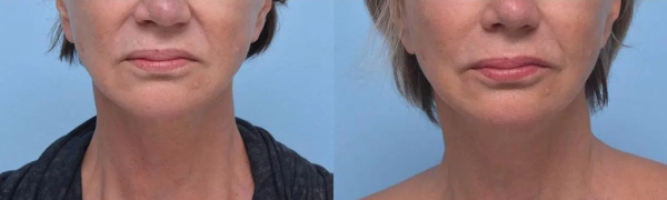 حقائق سريعة عن البوتوكس Botox