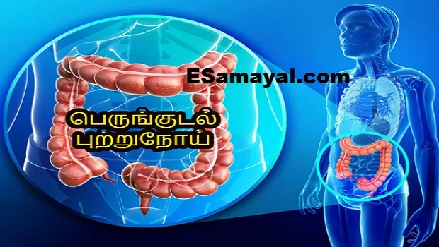 புற்றுநோயை உருவாக்கும் உணவுகள்