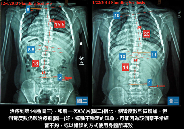 脊椎側彎, 脊椎側彎背架, 脊椎度數, 脊椎側彎矯正, 脊椎側彎治療, schroth運動, schroth脊椎側彎, 德國Schroth, 脊椎側彎矯正運動