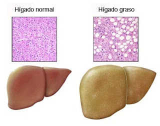 los-sintomas-higado-graso