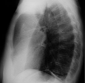 atelectasis causes, atelectasis causes, atelectasis symptoms, define atelectasis, what is atelectasis, pulmonary atelectasis, atelectasis pathofisiology