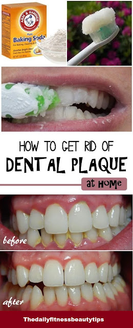 plaque tartar on teeth solutions