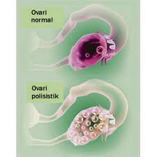 Jangan Pernah Berhenti: Aku PCOS