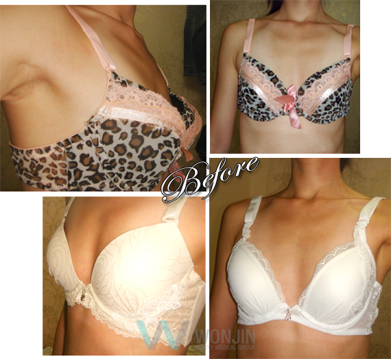 Photo for breast plastic surgery