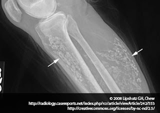 calcinoza cutanata radiografie