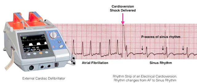 https://www.melbourneheartrhythm.com.au/learn/procedures/64-electrical-cardioversion