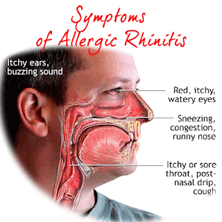 Allergic Rhinitis