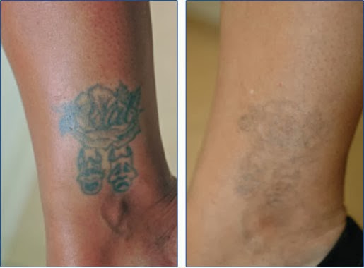 ... Remove Tattoos At Home - Dermabrasion | The Best Way To Removed Tattoo