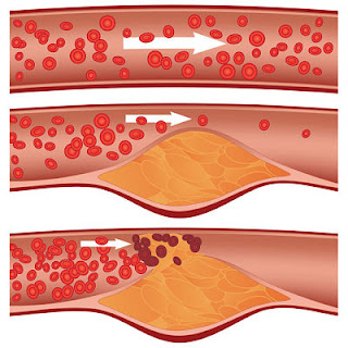 <img src="cómo-se-produce-la-arterosclerosis.jpg" alt="el taponamiento de las arterias es debido a que el colesterol malo se pega a las paredes arteriales"/>