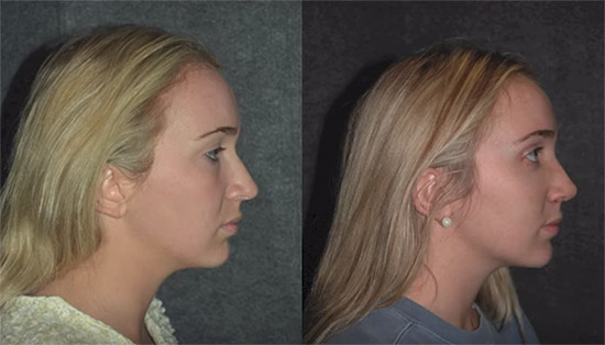 Rhinoplasty in Hyderabad