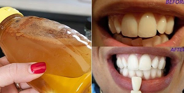 teeth and ACV