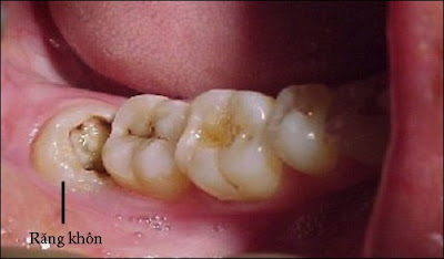 Cách điều trị răng khôn bị sâu ngoài nhổ răng