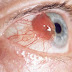 Eye Cancer (Melanoma): Causes, Symptoms in addition to Treatmen