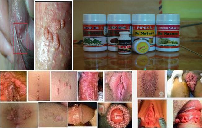 obat salep kutil kelamin