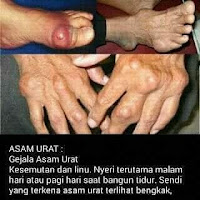 Obat Asam Urat Alami Paling Ampuh Saat Ini